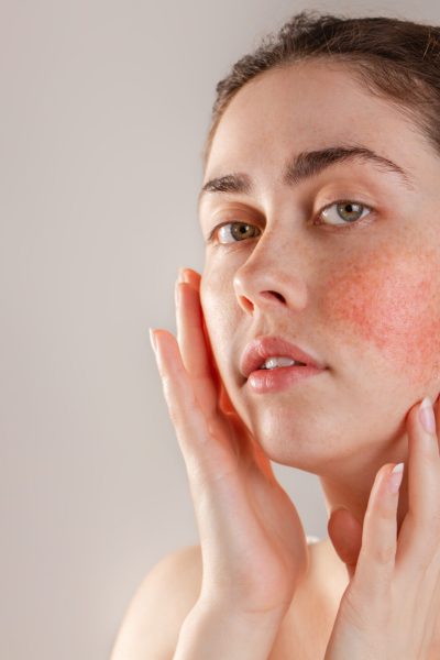 The face is the area where skin sensitivity is most observed, but this sensitivity can be seen in any part of the body.
